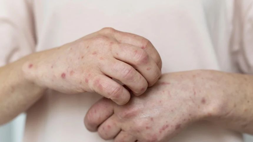 Kasus Campak Naik, Menkes Soroti Rendahnya Imunisasi dan Mobilitas Anak Sekolah