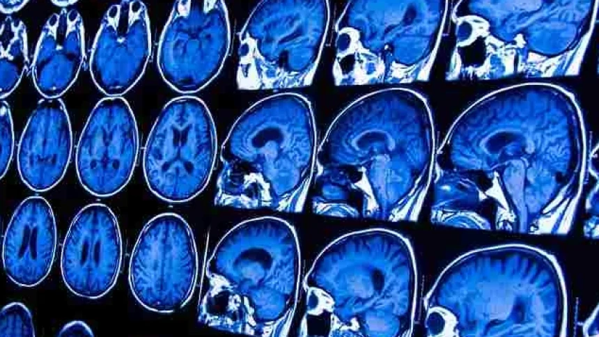 Beberapa Faktor yang Bisa Menjadi Penyebab Mati Batang Otak