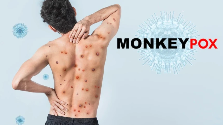 Monkeypox Dikonfirmasi Masuk Indonesia, Ini Penularan dan Upaya Pencegahannya