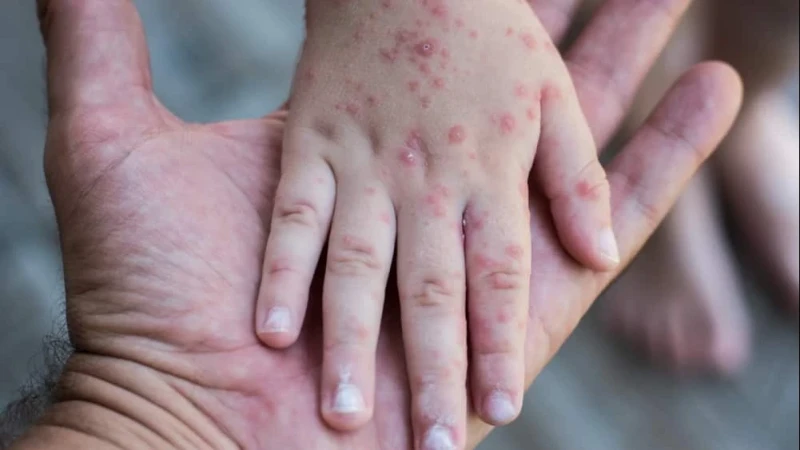 Teridentifikasi di 12 Negara, Ini Upaya Pencegahan Monkeypox yang Bisa Dilakukan