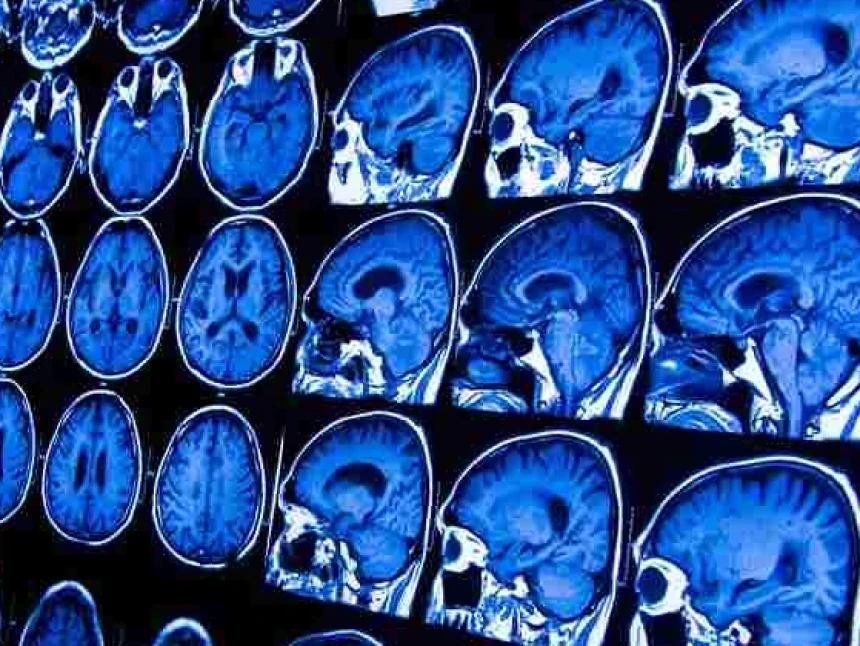 Beberapa Faktor yang Bisa Menjadi Penyebab Mati Batang Otak