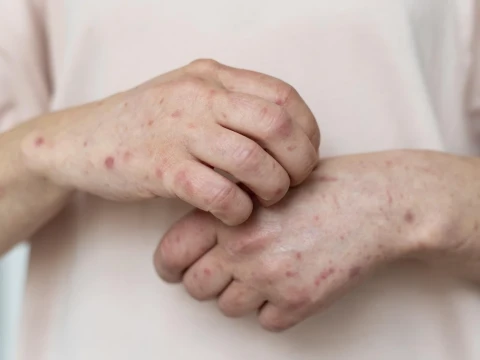 Kasus Campak Naik, Menkes Soroti Rendahnya Imunisasi dan Mobilitas Anak Sekolah