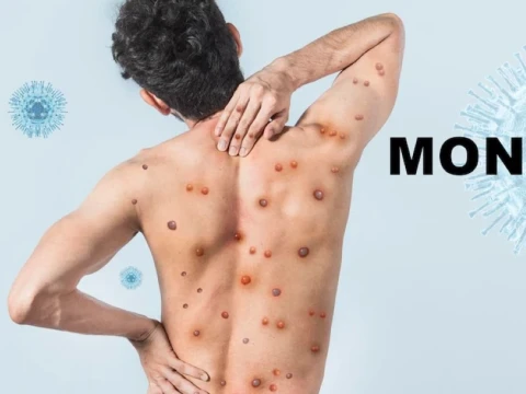 Monkeypox Dikonfirmasi Masuk Indonesia, Ini Penularan dan Upaya Pencegahannya